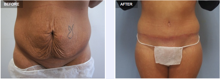 Tummy Tuck - Before & After Images - The Private Clinic of Harley Street  London