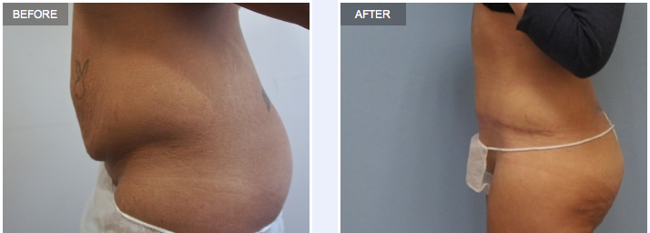 Tummy tuck before & after (side view)