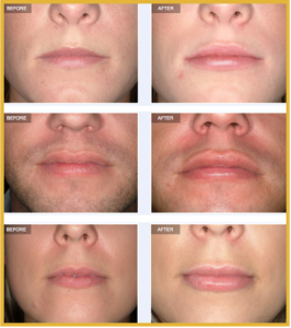 Permalip lip implants Before and After