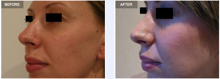 Rhinoplasty Profile Before and After