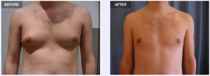 Could your 'man boobs' be Gynecomastia?