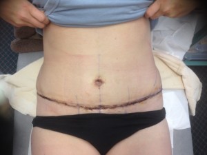 1 week after my tummy tuck surgery