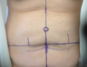 Diary of a Tummy Tuck surgery