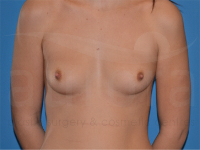 Before-Breast Enlargement