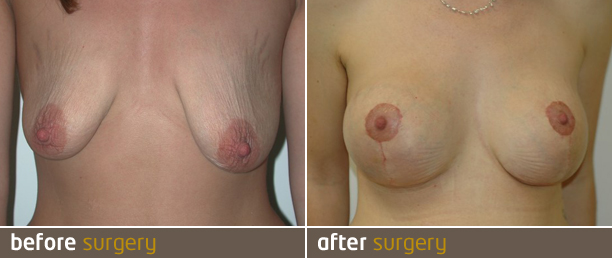Aurora Clinics: Sagging breasts treated with an uplift
