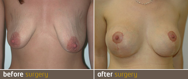 Sagging breasts? Do you need breast implants or an uplift?