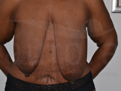 Breast uplift before and after photographs