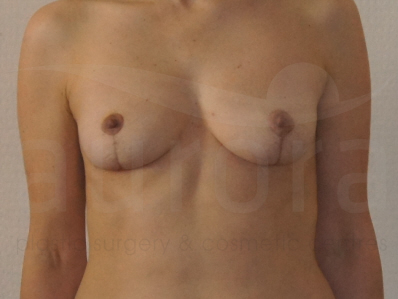After-Breast Uplift Surgery